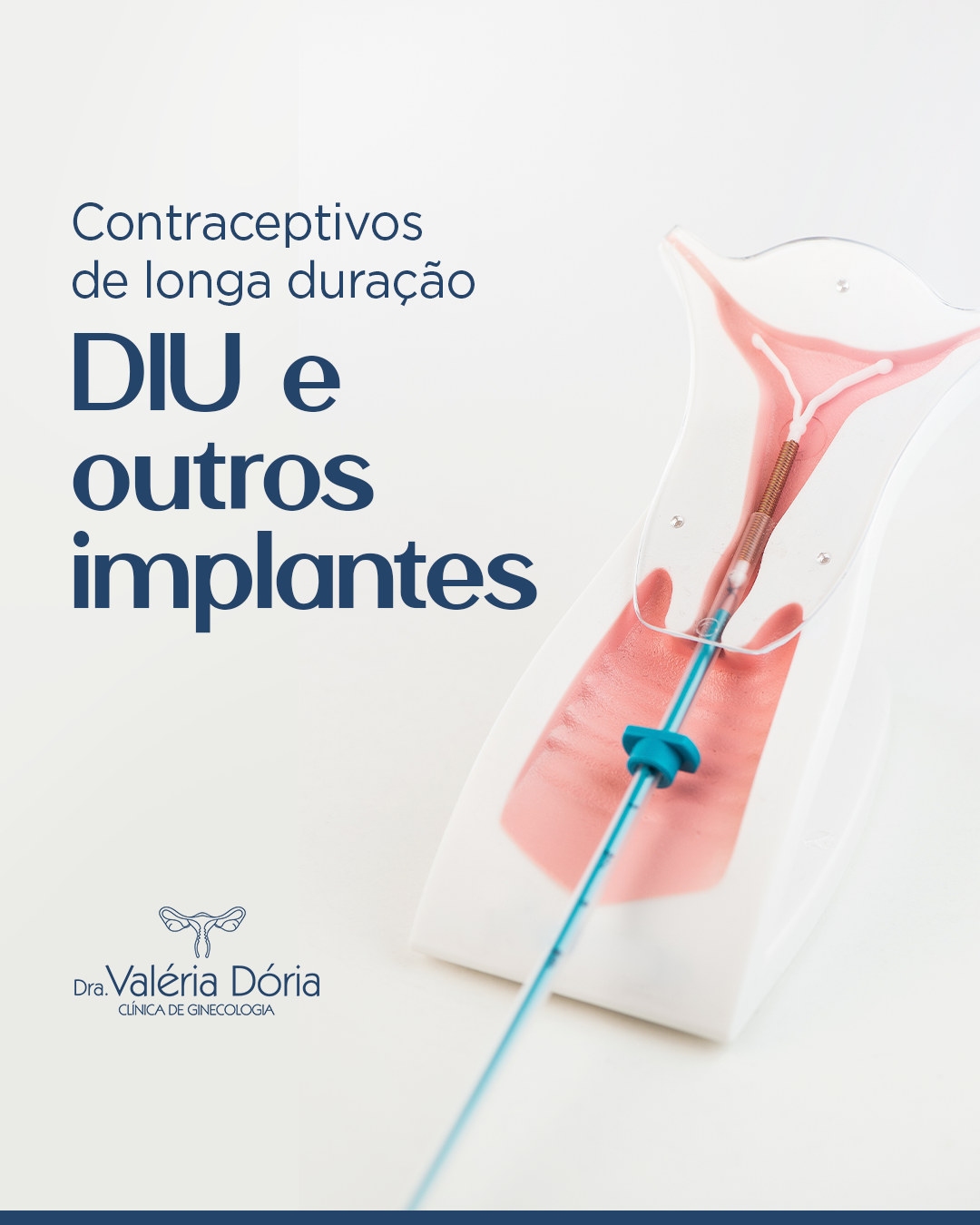 Contraceptivos de longa duração: DIU e outros implantes